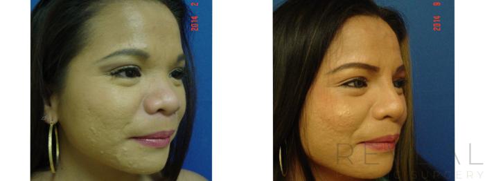 Before & After Asian Rhinoplasty Case 157 View #3 View in San Jose, CA