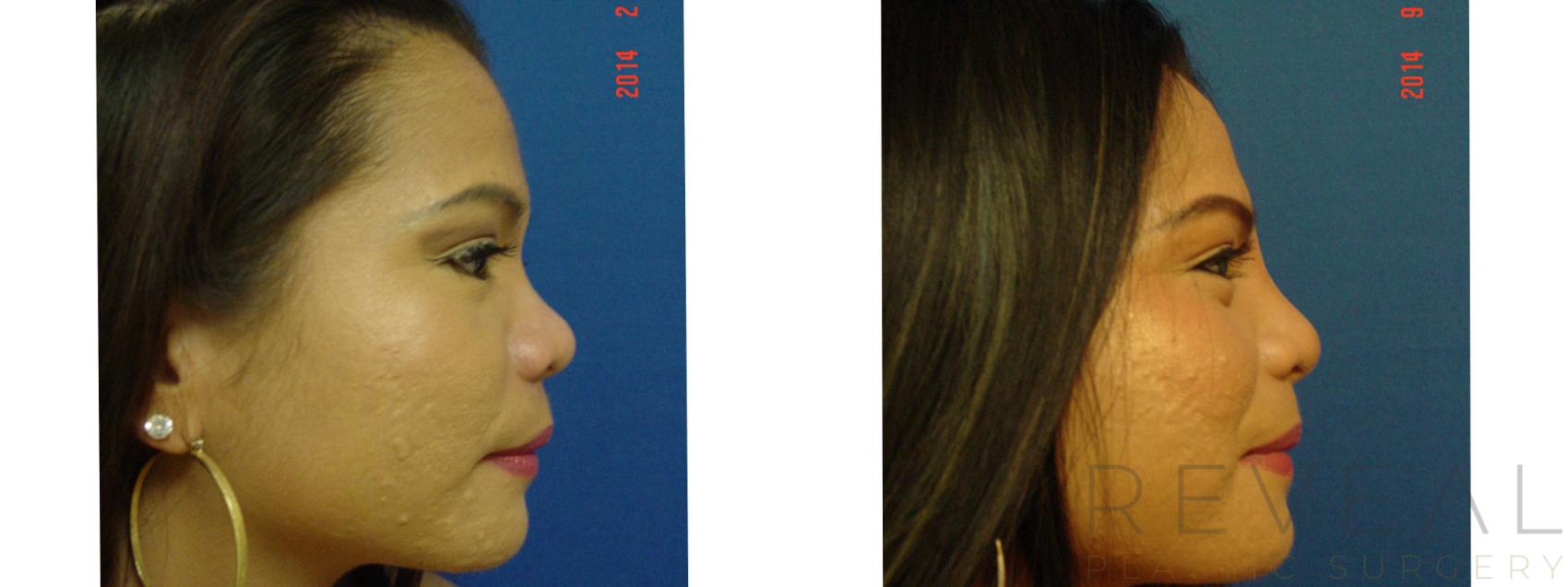 Before & After Rhinoplasty Case 157 View #4 View in San Jose, CA