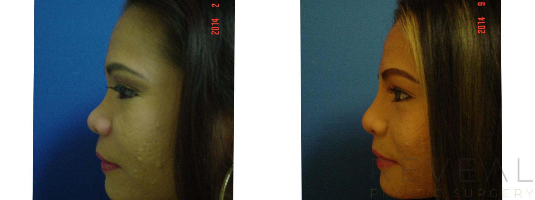 Before & After Rhinoplasty Case 157 View #5 View in San Jose, CA