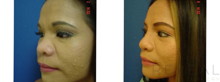 Before & After Asian Rhinoplasty Case 157 View #6 View in San Jose, CA