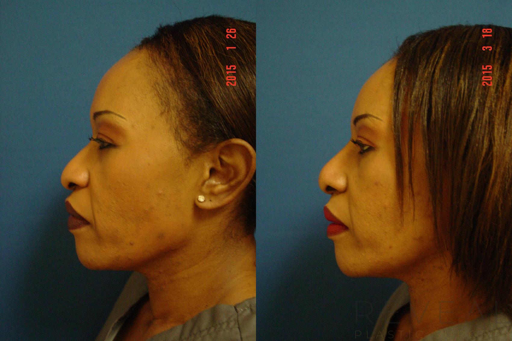 Before & After Rhinoplasty Case 172 View #1 View in San Jose, CA