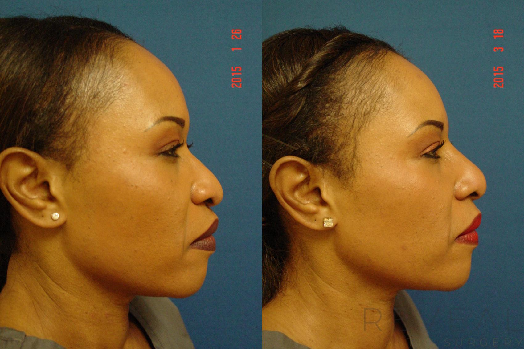 Before & After Rhinoplasty Case 172 View #2 View in San Jose, CA