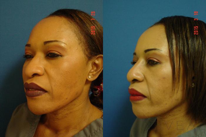 Before & After Rhinoplasty Case 172 View #5 View in San Jose, CA