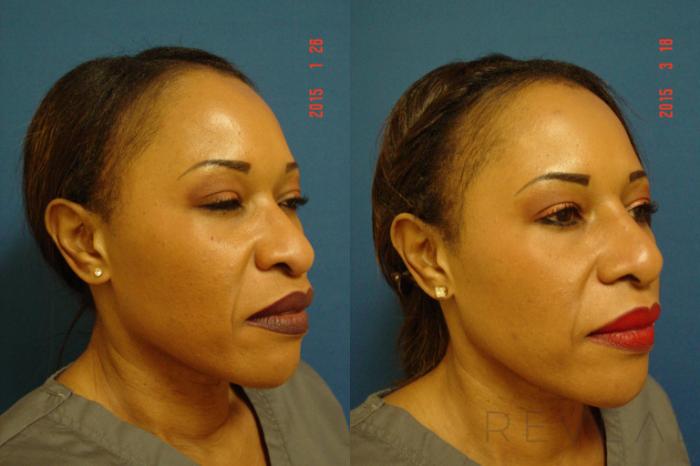 Before & After Rhinoplasty Case 172 View #6 View in San Jose, CA