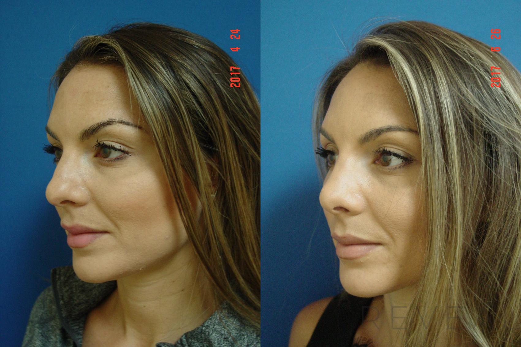 Before & After Rhinoplasty Case 224 View #1 View in San Jose, CA