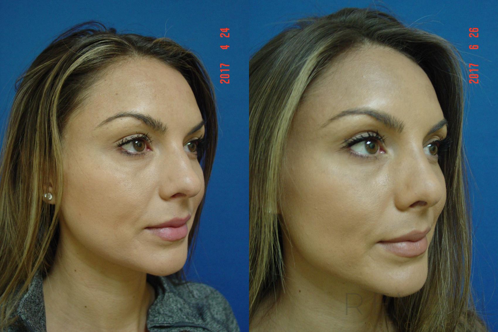 Before & After Rhinoplasty Case 224 View #2 View in San Jose, CA