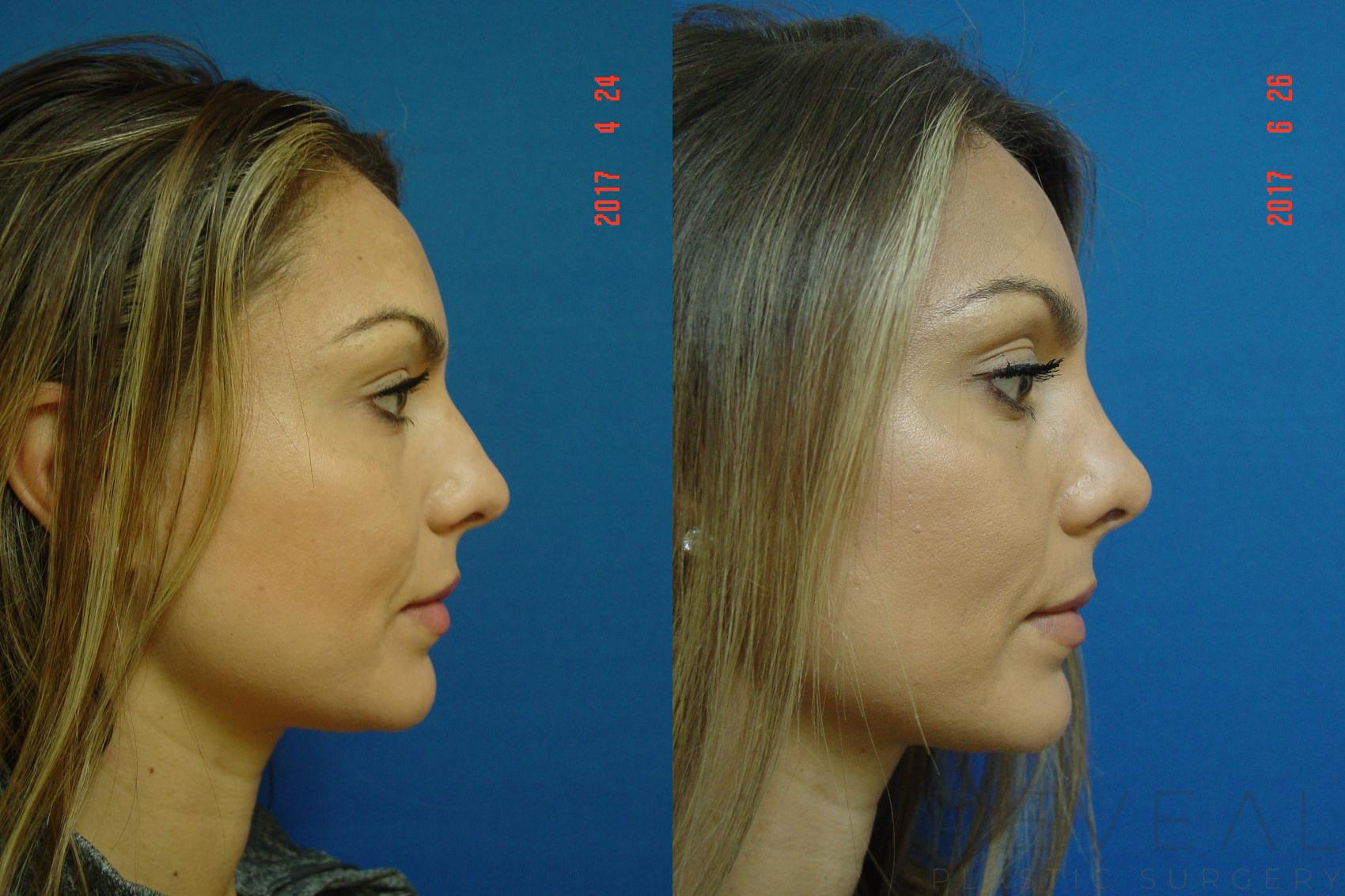 Before & After Rhinoplasty Case 224 View #3 View in San Jose, CA