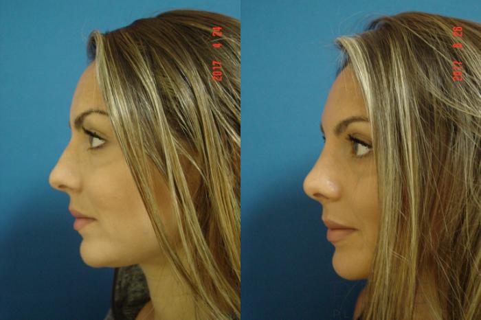 Before & After Rhinoplasty Case 224 View #4 View in San Jose, CA