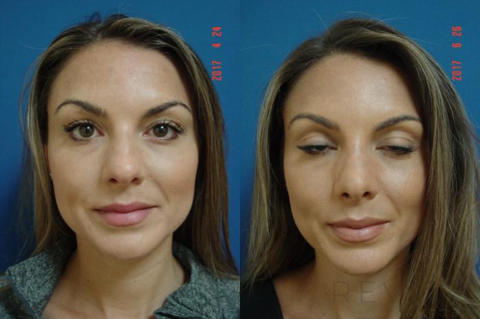 Before & After Rhinoplasty Case 224 View #5 View in San Jose, CA