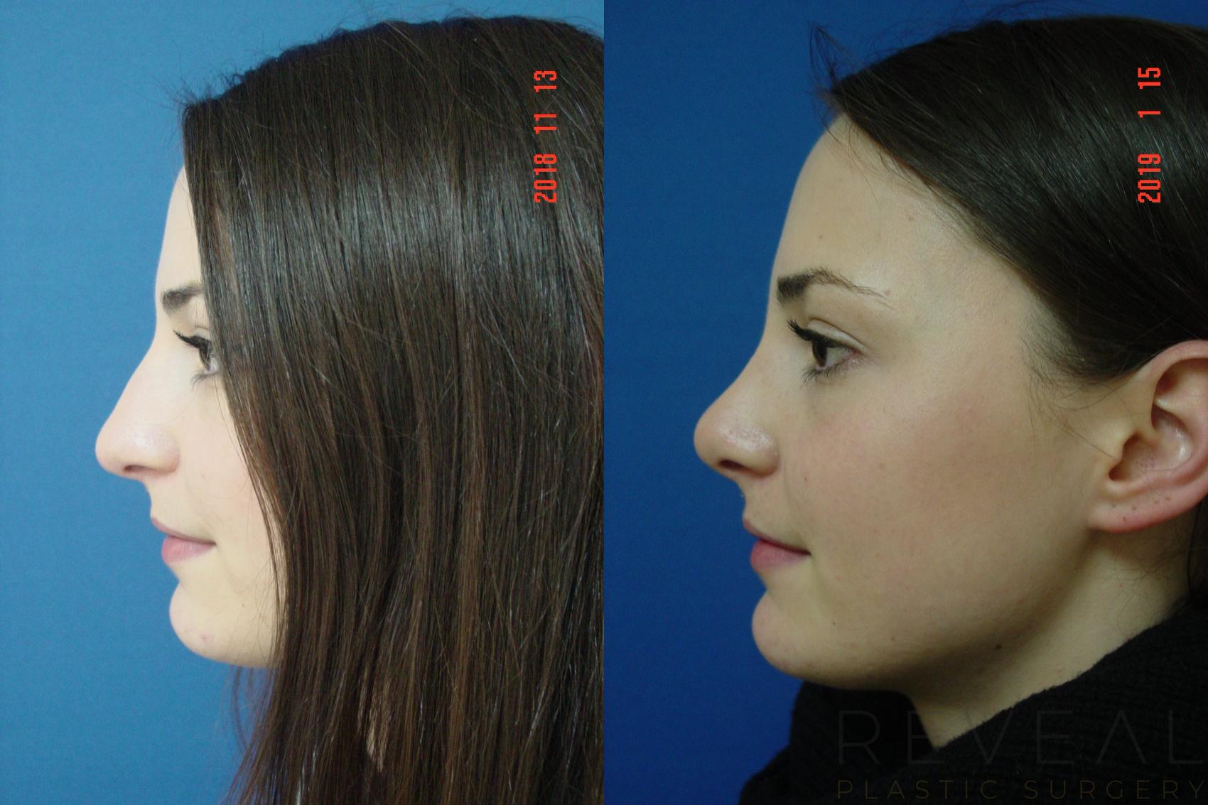 Before & After Rhinoplasty Case 282 View #1 View in San Jose, CA
