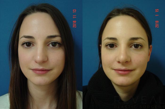 Before & After Rhinoplasty Case 282 View #2 View in San Jose, CA