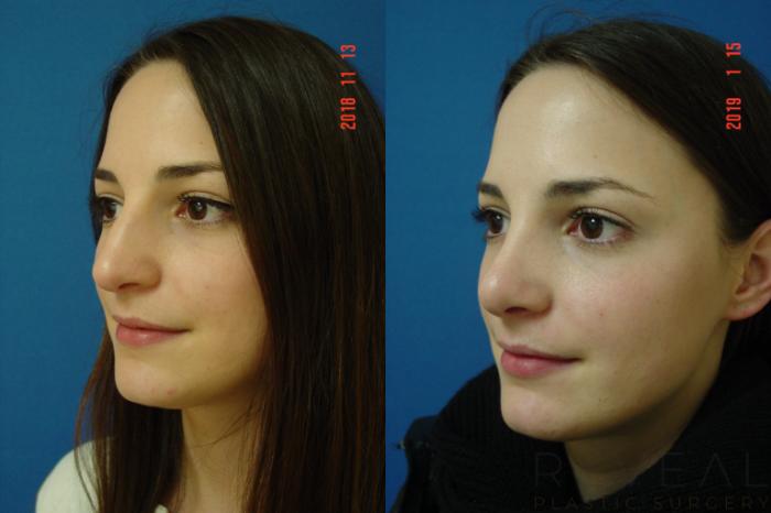 Before & After Rhinoplasty Case 282 View #3 View in San Jose, CA