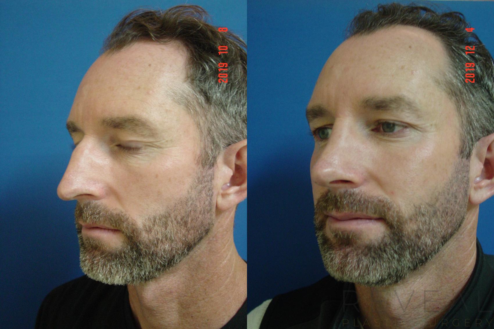 Before & After Rhinoplasty Case 380 View #1 View in San Jose, CA