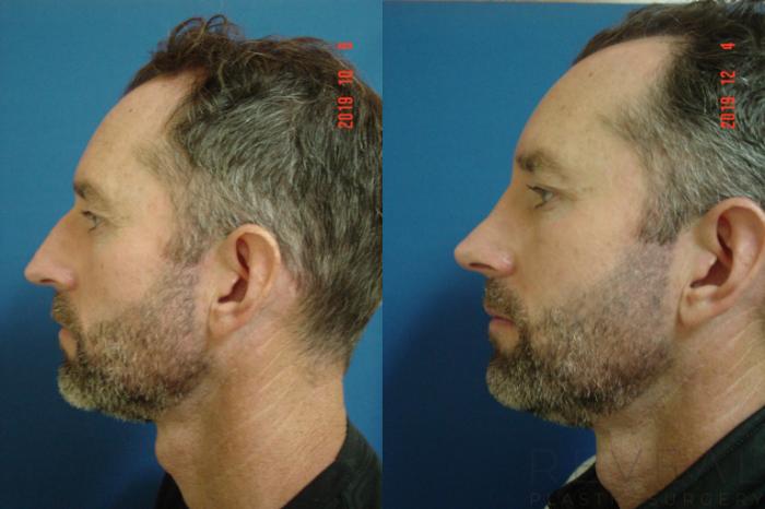 Before & After Rhinoplasty Case 380 View #2 View in San Jose, CA