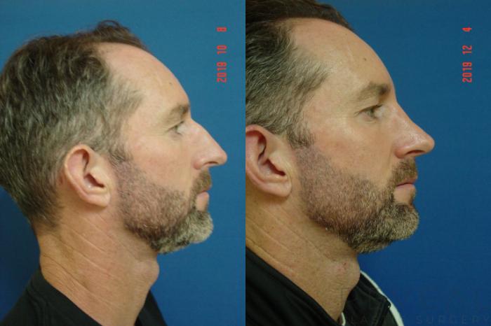 Before & After Rhinoplasty Case 380 View #3 View in San Jose, CA