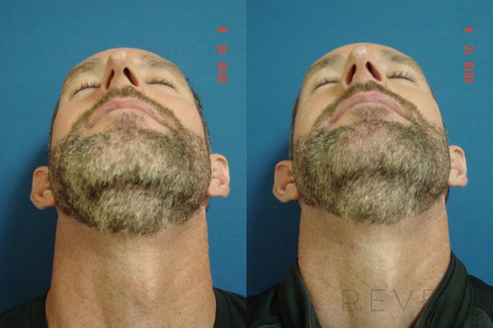 Before & After Rhinoplasty Case 380 View #6 View in San Jose, CA