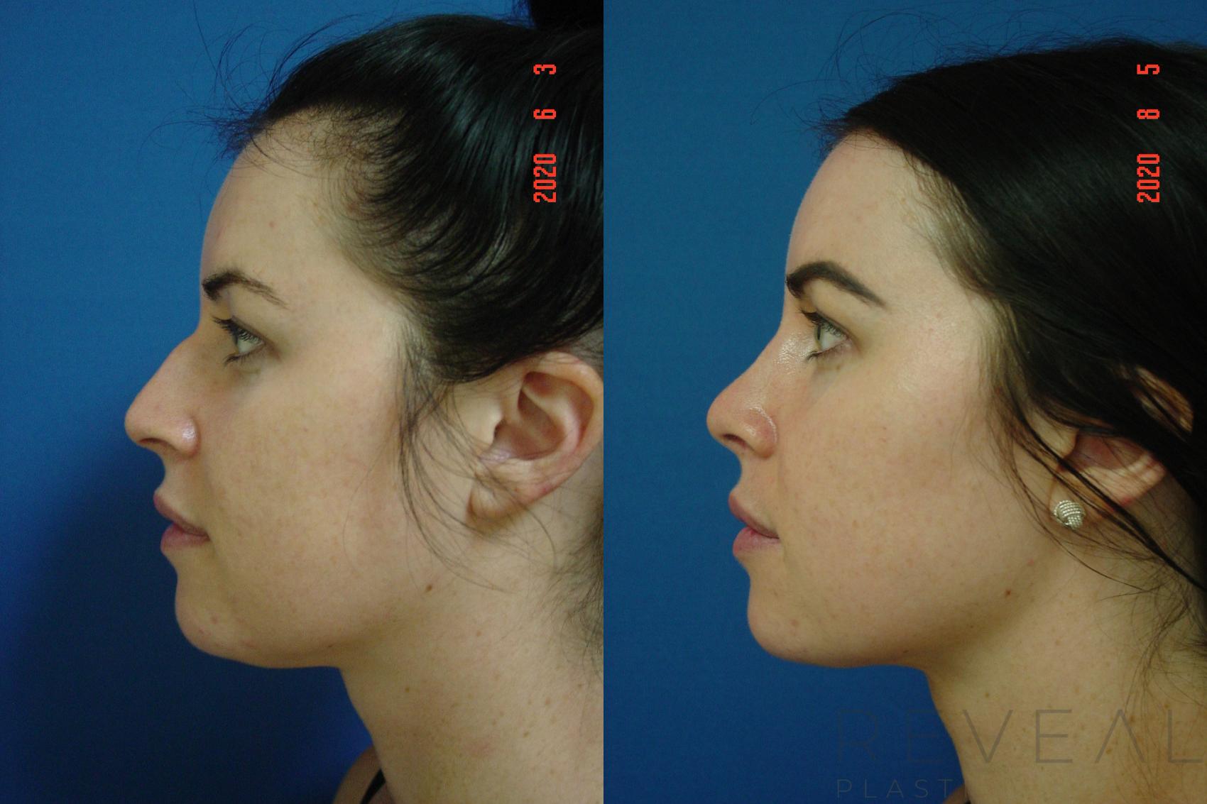 Before & After Rhinoplasty Case 400 View #1 View in San Jose, CA