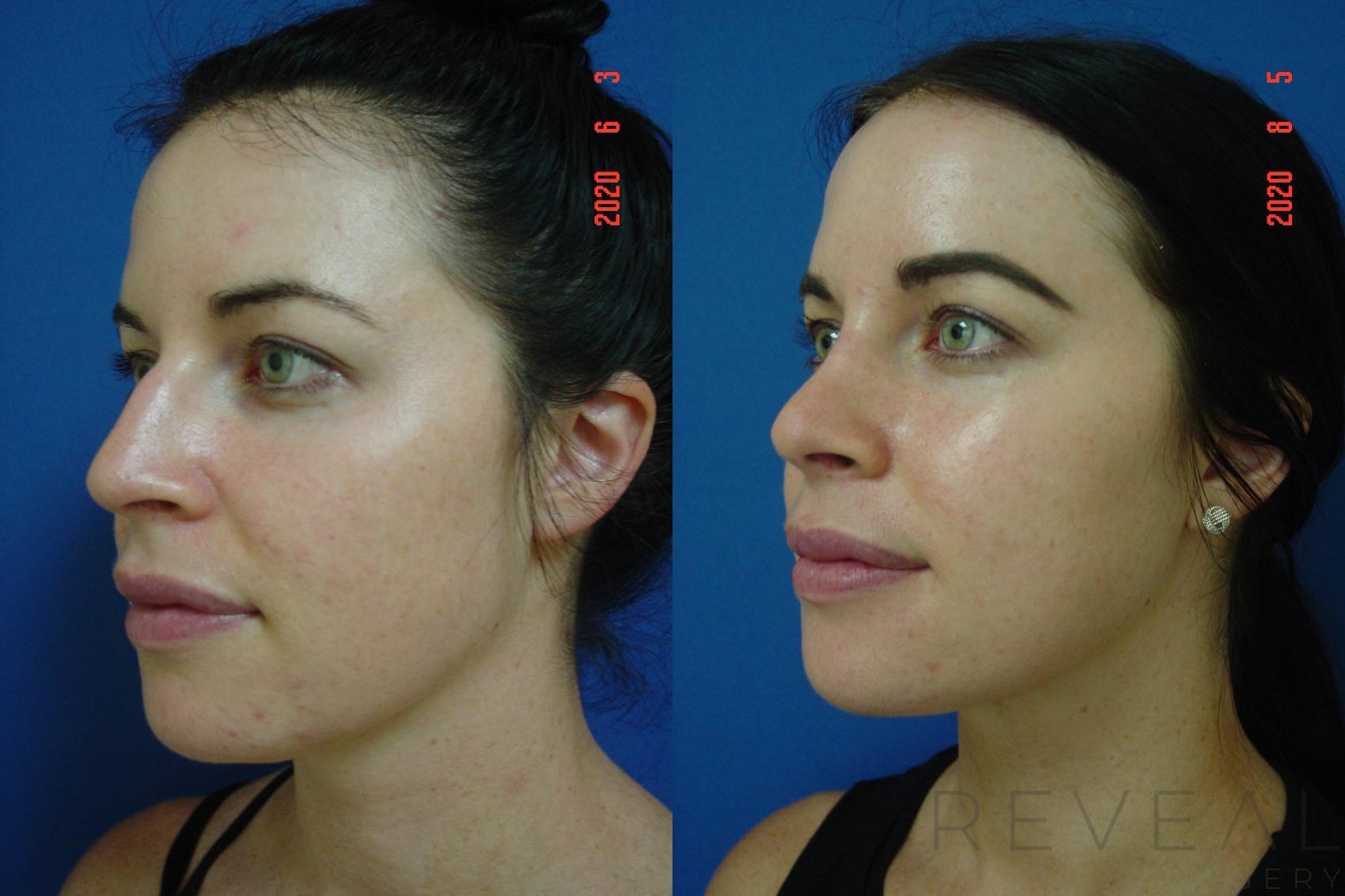 Before & After Rhinoplasty Case 400 View #2 View in San Jose, CA
