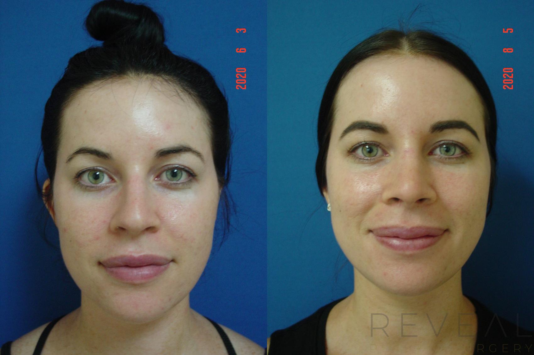 Before & After Rhinoplasty Case 400 View #3 View in San Jose, CA