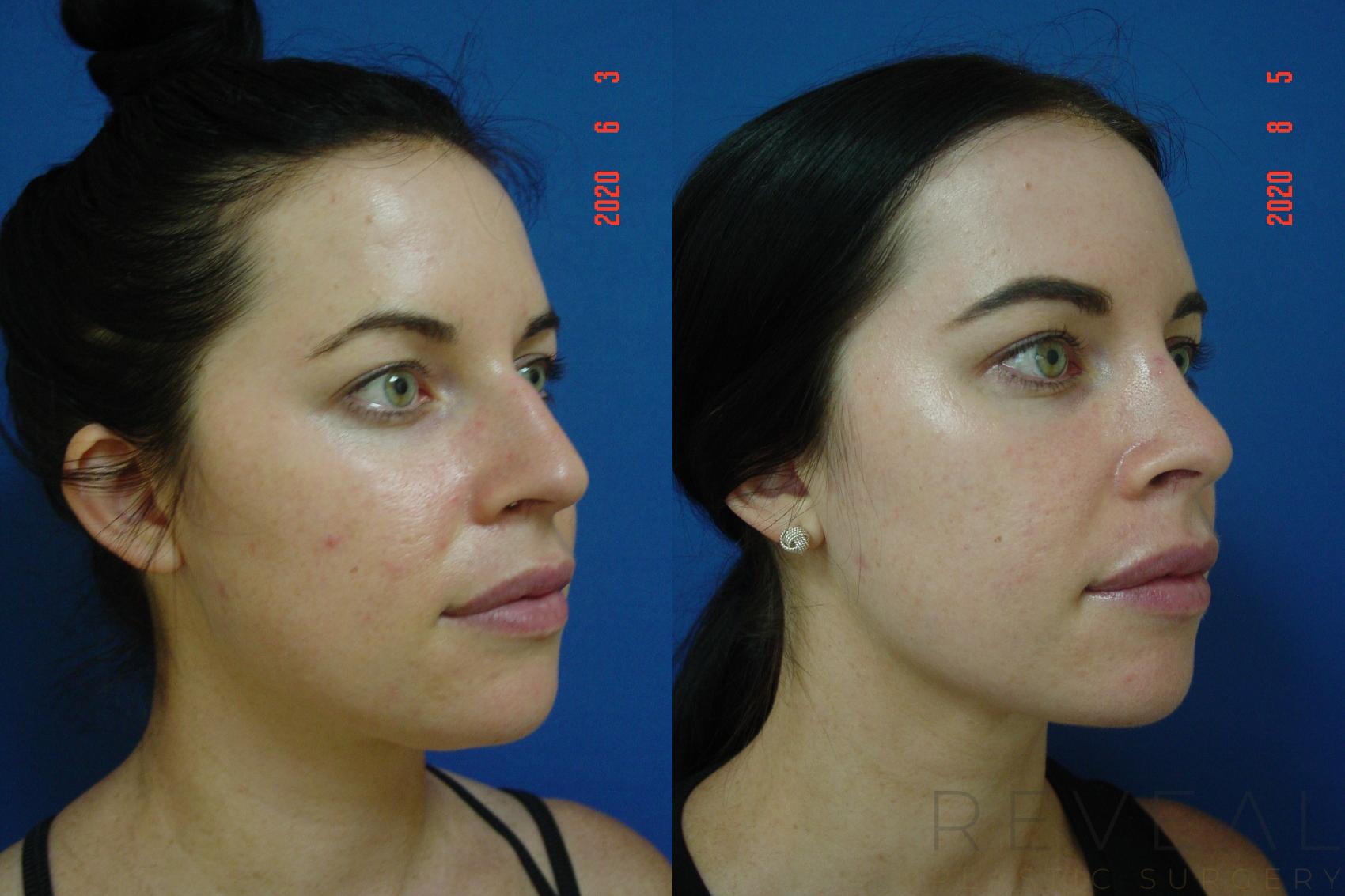 Before & After Rhinoplasty Case 400 View #4 View in San Jose, CA