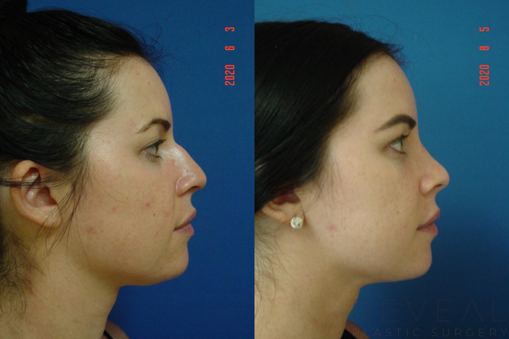 Before & After Rhinoplasty Case 400 View #5 View in San Jose, CA