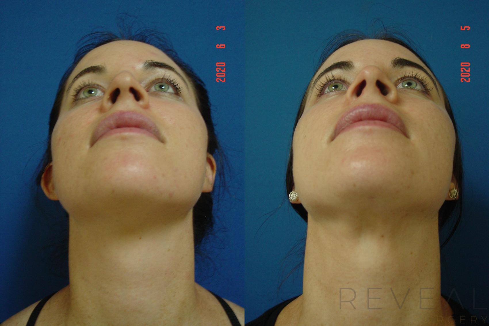 Before & After Rhinoplasty Case 400 View #6 View in San Jose, CA
