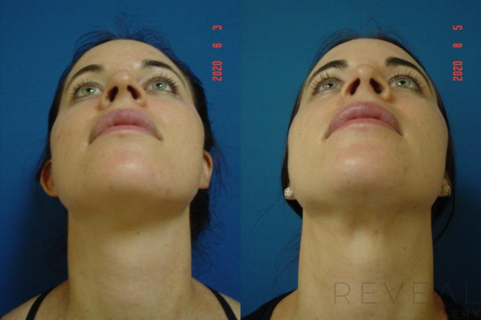 Before & After Liposuction Case 400 View #6 View in San Jose, CA