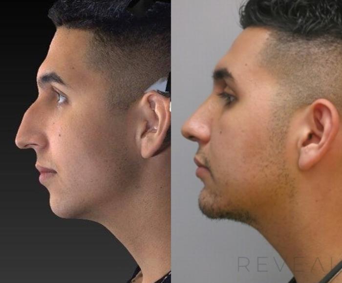 Before & After Rhinoplasty Case 419 View #1 View in San Jose, CA
