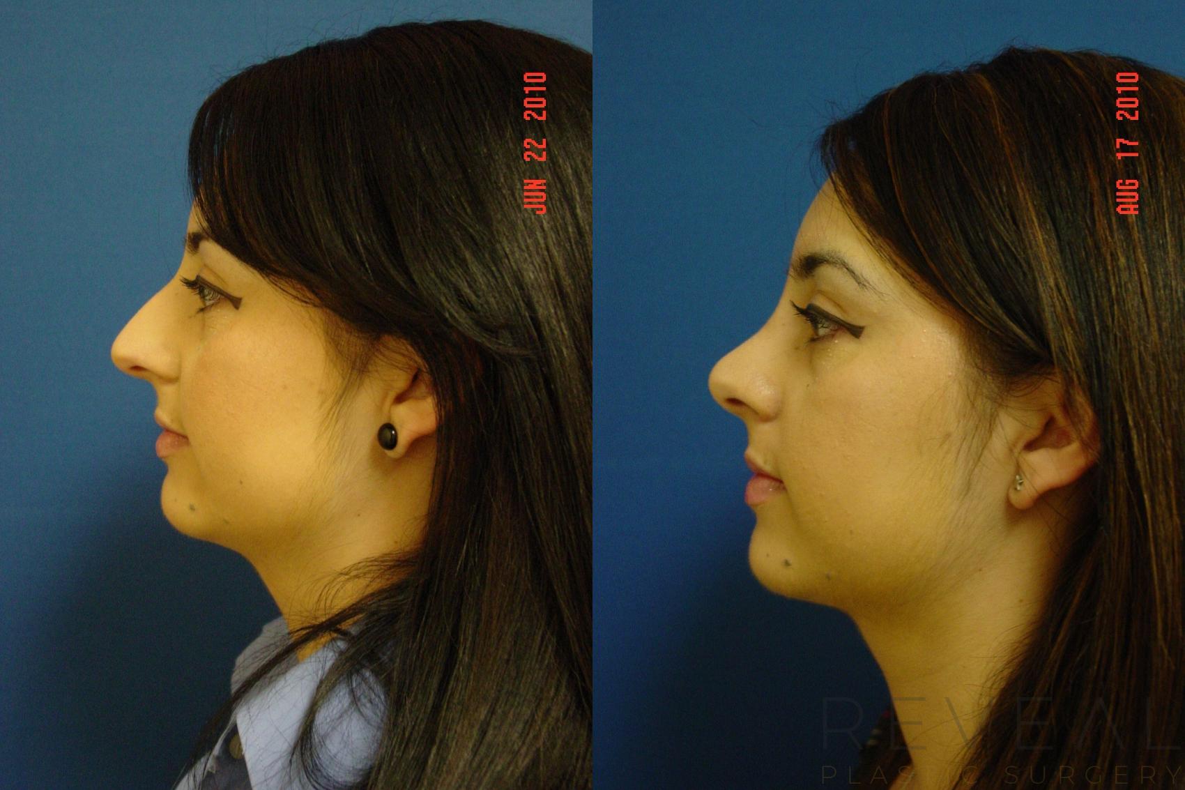 Before & After Rhinoplasty Case 44 View #1 View in San Jose, CA