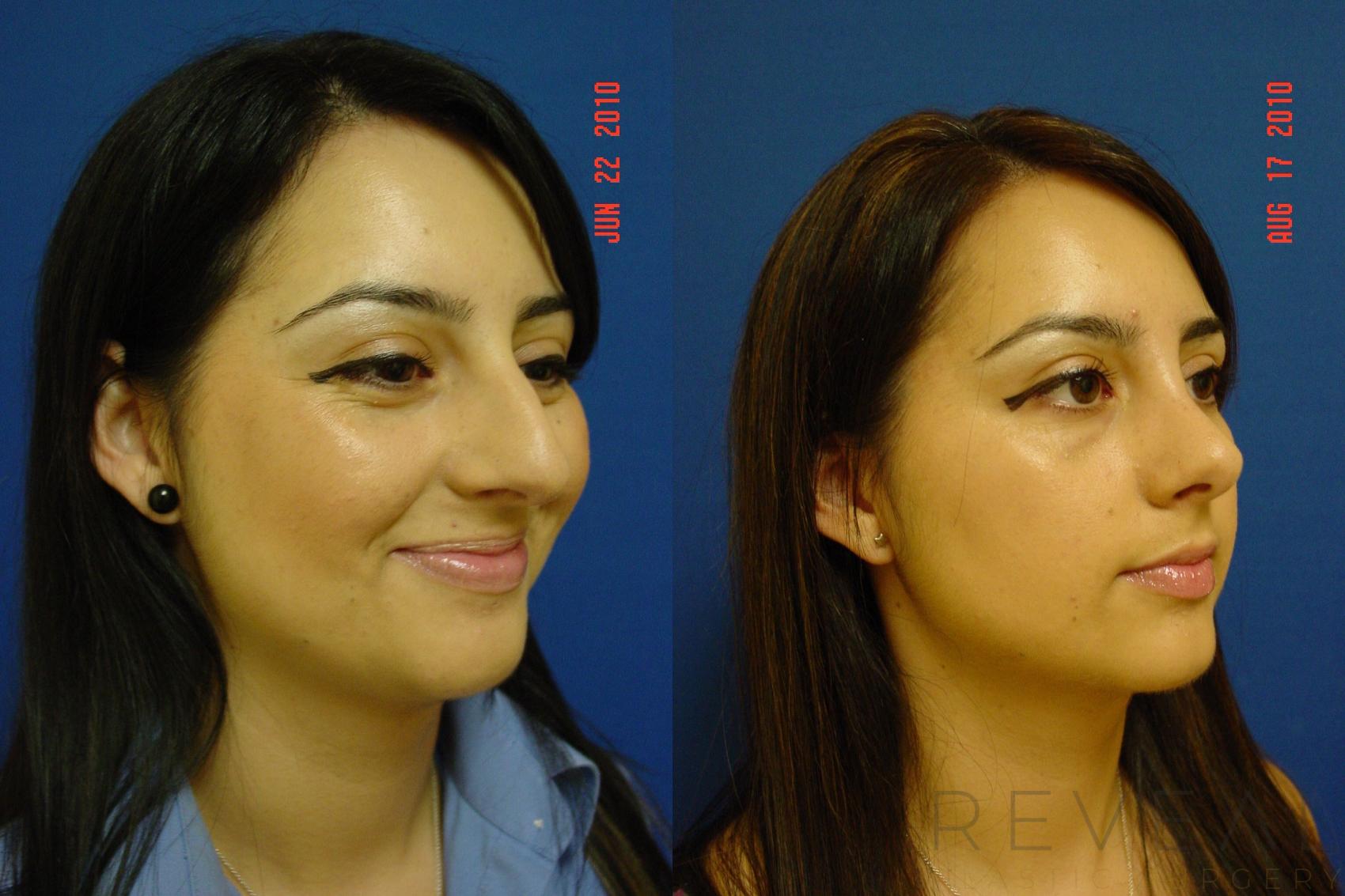 Before & After Rhinoplasty Case 44 View #2 View in San Jose, CA