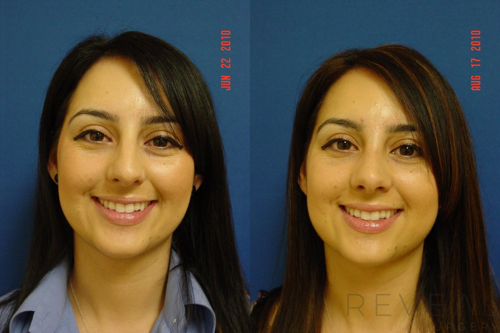 Before & After Rhinoplasty Case 44 View #3 View in San Jose, CA