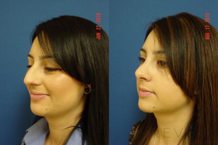 Before & After Rhinoplasty Case 44 View #4 View in San Jose, CA