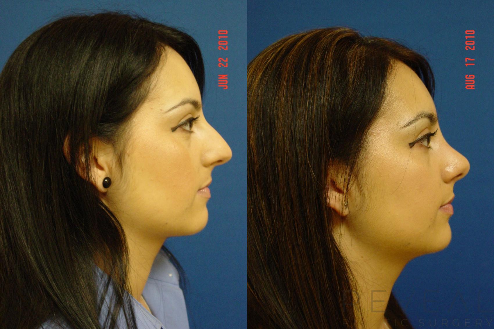 Before & After Rhinoplasty Case 44 View #5 View in San Jose, CA