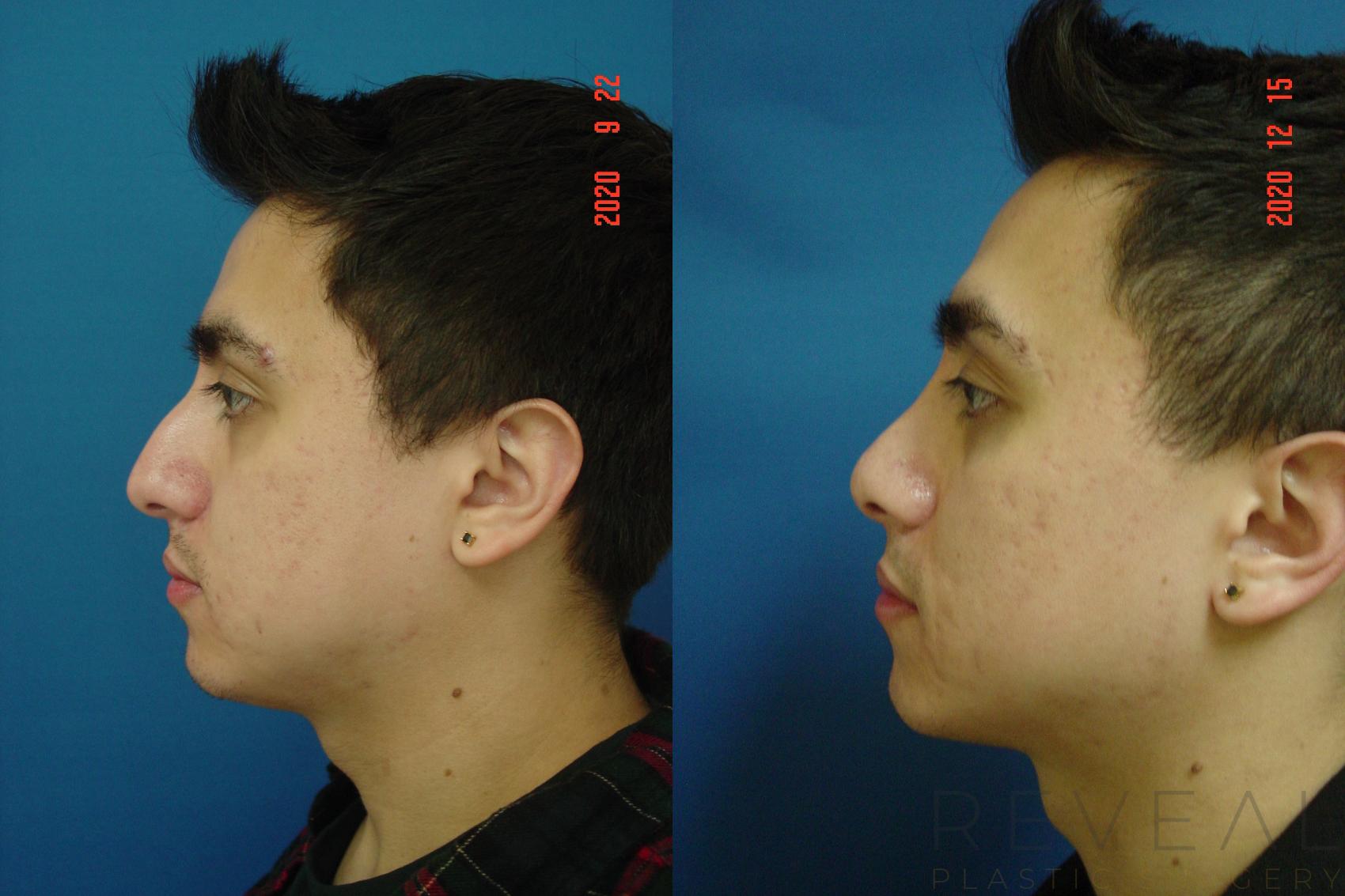 Before & After Rhinoplasty Case 476 View #1 View in San Jose, CA