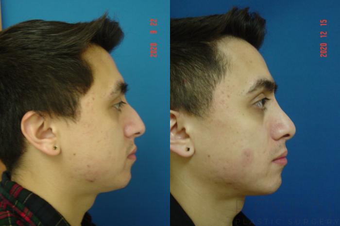 Before & After Rhinoplasty Case 476 View #2 View in San Jose, CA