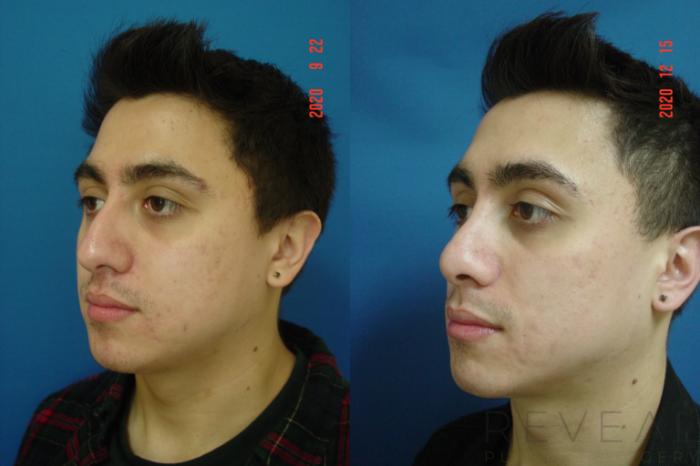 Before & After Rhinoplasty Case 476 View #3 View in San Jose, CA