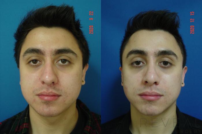 Before & After Rhinoplasty Case 476 View #5 View in San Jose, CA
