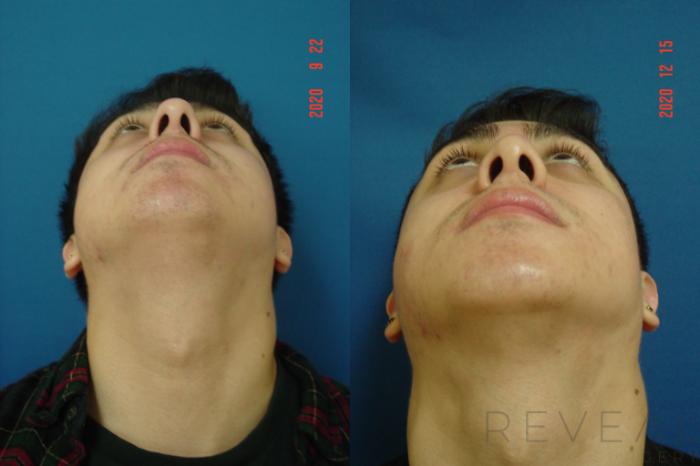 Before & After Rhinoplasty Case 476 View #6 View in San Jose, CA