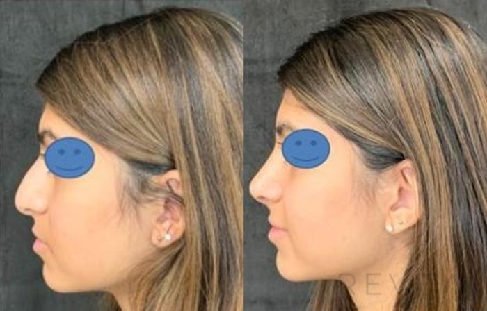 Before & After Rhinoplasty Case 478 View #2 View in San Jose, CA