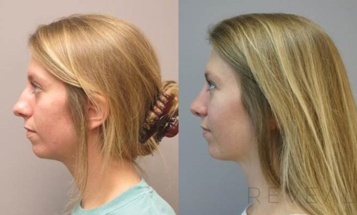 Before & After Rhinoplasty Case 488 View #1 View in San Jose, CA