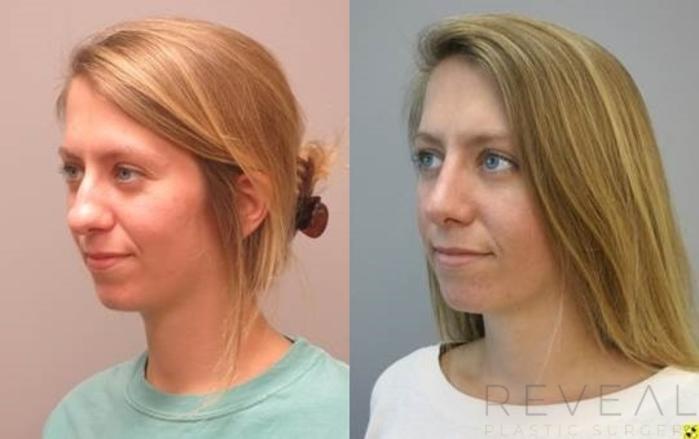 Before & After Rhinoplasty Case 488 View #2 View in San Jose, CA