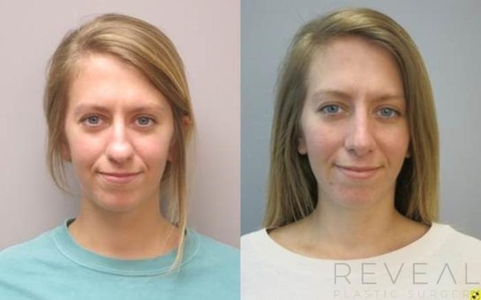 Before & After Rhinoplasty Case 488 View #3 View in San Jose, CA