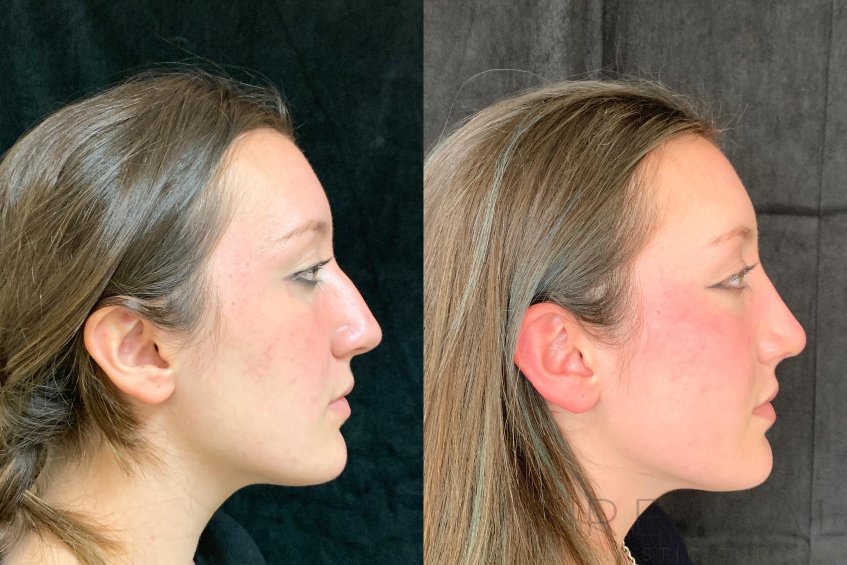 Before & After Rhinoplasty Case 503 View #1 View in San Jose, CA
