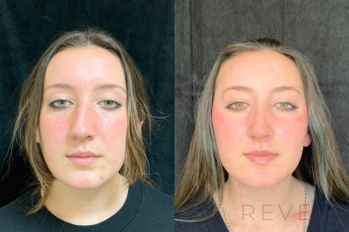 Before & After Rhinoplasty Case 503 View #2 View in San Jose, CA