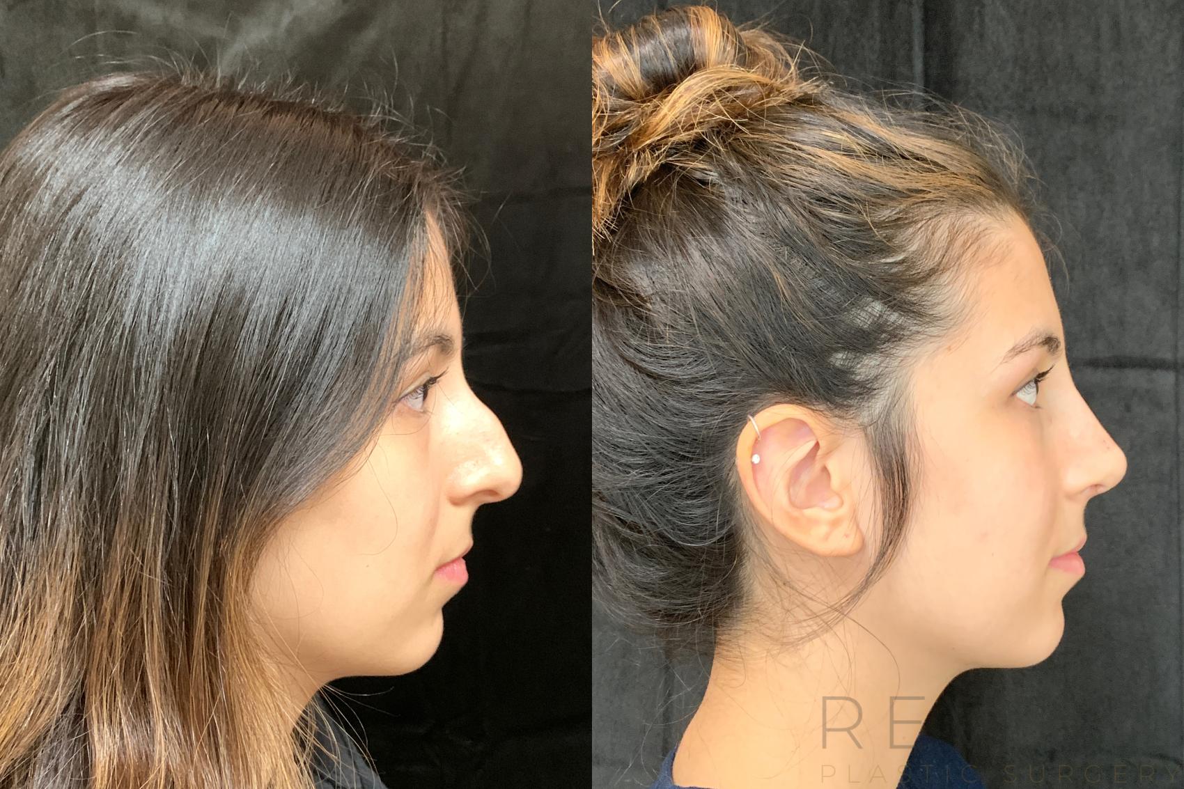 Before & After Rhinoplasty Case 511 View #1 View in San Jose, CA