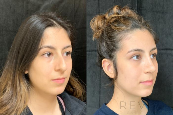 Before & After Rhinoplasty Case 511 View #2 View in San Jose, CA