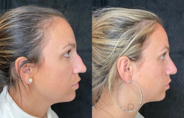 Before & After Rhinoplasty Case 548 View #1 View in San Jose, CA