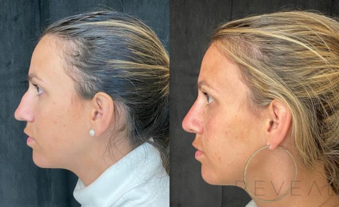 Before & After Rhinoplasty Case 548 View #2 View in San Jose, CA