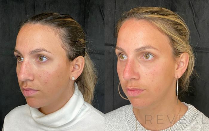 Before & After Rhinoplasty Case 548 View #3 View in San Jose, CA