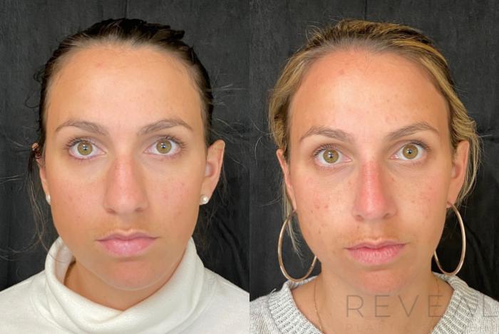 Before & After Rhinoplasty Case 548 View #4 View in San Jose, CA